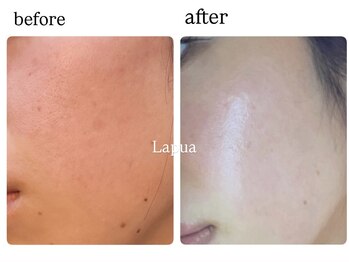 ラプア(Lapua)/つや爆発☆水光肌に導く