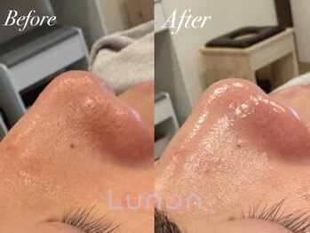 ルノン(Lunon)/毛穴洗浄ハイドロ