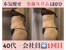 マール(Mar)/ビフォーアフター/痩身/全身痩せ