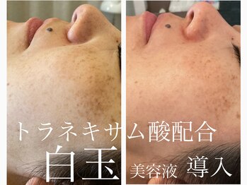 グレイティア(gratia)の写真/当店人気の白玉美容液でシミ◯班くすみにまとめてアプローチ♪シミ予防にも♪明るくハリのあるお肌へ☆