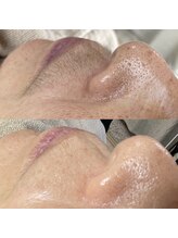 ミーミドットアイ(Mi-mi.i)/口周りワックス脱毛