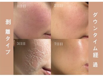 アルフォービューティー 恵比寿店(ALU for beauty)/ローズドメーラ経過症例