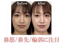 隆鼻矯正専門店 ラプリ(Raplit)/隆鼻＋輪郭矯正40分10回