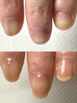 ハッチネイル(HACCI nail)/自爪育成　深爪矯正