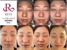 レヴィア 東大宮店(REVIA)の雰囲気（何しても改善されなかった肌悩み一度ご相談ください★）