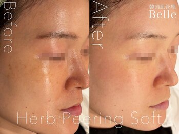 ベル 北千住(Belle)/ハーブピーリング|ニキビケア