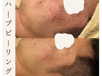 ミウ(MIU)/【 ハーブピーリング 】