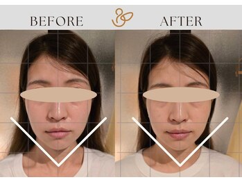 チョコバリ 渋谷店(chocobari)/小顔×リフトアップ(美容鍼)20代