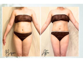 ポノ 茅ヶ崎(Pono.)/セルゼロ2か月の変化【痩身】