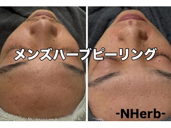 エヌハーブ(NHerb)/剥けるハーブ5回目男性30代