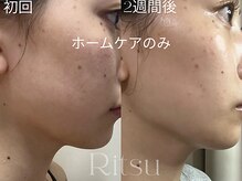 リツ(Ritsu)/二重顎/リフトアップ