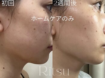 リツ(Ritsu)/二重顎/リフトアップ
