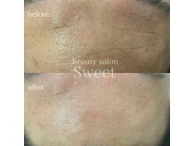 トロイアルケ【ホームケア3ケ月】