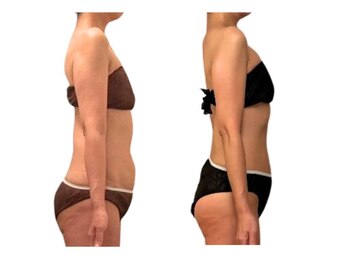 フィニシオン/50代 &nbsp;&nbsp;6ヶ月後