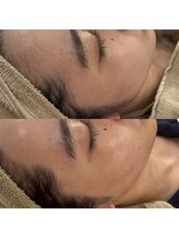 スイ 四条烏丸(SUI)/（お顔剃り》エステ&肌メイク