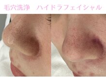 Cスキンケアクリニック 麻布店/毛穴洗浄ハイドラフェイシャル