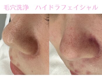 Cスキンケアクリニック 麻布店/毛穴洗浄ハイドラフェイシャル