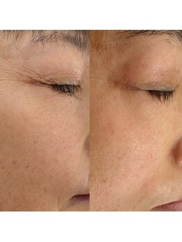 ミント(mint)/#毛穴洗浄#ハーブピーリング