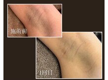 スパロウ(RF sparrow)/２１歳　女性