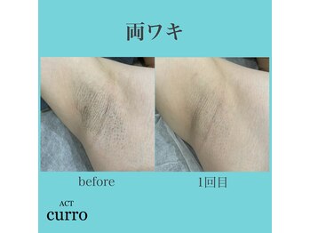 アクト クロ(ACT curro)/【両ワキ】脱毛施術例