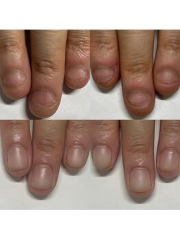 マニュコクーン(ManuCocoon)/爪育成 深爪 巻き爪 大阪市