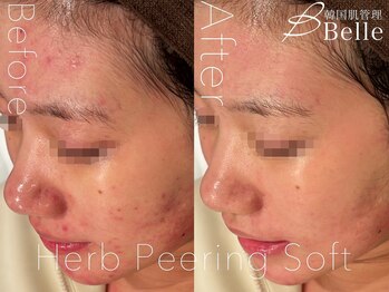 ベル 北千住(Belle)/ハーブピーリング|ニキビケア
