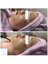 サロン ド パーフェクション(Salon de Perfection)/小顔リフト