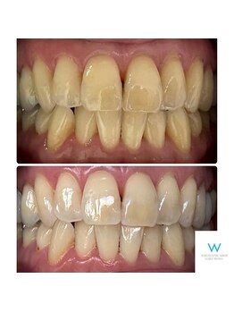 ホワイトニングショップ 奈良生駒店/1回でもこんなに変わります！！