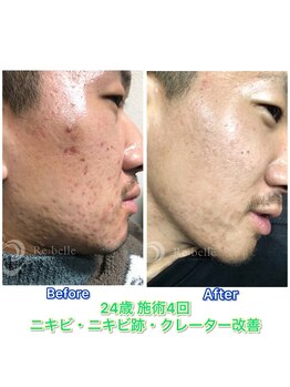 ブルービードロ(Blue beedro)/Before/After