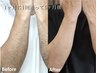 【初回男性】全身（顔・VIO無し）¥9,800☆ローンなし！完全都度払い