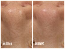 キーオブフェイス(Key of Face)/お悩み【毛穴のざらつき】