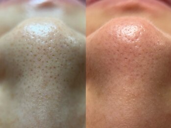 フェリス(FELIZ)/感動を呼ぶ毛穴洗浄