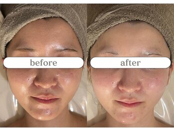 リスタ(RSTA)/【BEFORE/AFTER】