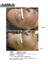 ミウル 天王寺店(miulu)/シミ照射＋ハーブピーリング