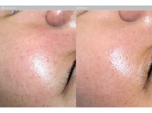 ルートリー(Rootree)/肌管理フェイシャルケア