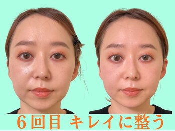 ナチュラルパーフェクトフェイス 新宿/６回目・理想の小顔に/新宿小顔