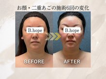 ビーホープ(B.hope)の雰囲気（40代のお客様お顔・二重あごの施術6回の変化 新大阪/東三国）
