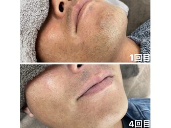 カルディエ(Cardie)/ひげ脱毛　ビフォーアフター