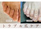 トラブル爪ケア