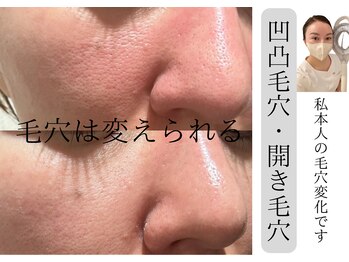 サロン イナンナ(Salon INANNA)/開き毛穴/毛穴の黒ずみ/尾張旭