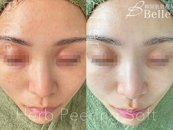 ベル 北千住(Belle)/ハーブピーリング|ニキビケア