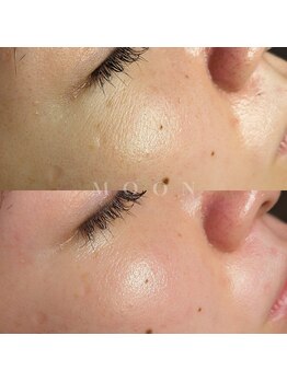 ムーン 横浜(MOON)/【フェイス】