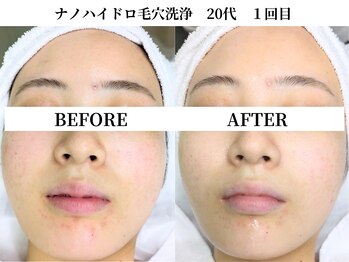 サンビ(SANBI)/毛穴洗浄で美肌に生まれ変わる★