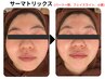 【お試し/たるみケア】サーマトリックスで即攻小顔☆選べる箇所3パーツ