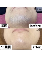 メンズ脱毛サロンKurozukin　天王寺店/大阪/天王寺/阿倍野◇メンズ脱毛