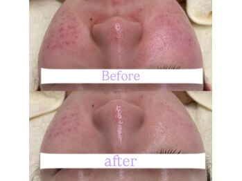 クレア(Claire)/乳酸菌1回、ハーブピーリング1回