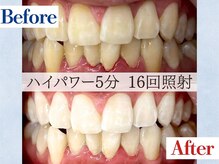 LBSホワイトニング 吉祥寺店/ホワイトニングビフォーアフター