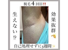 オークツリー(oak tree)/男性脱毛《ワキ》