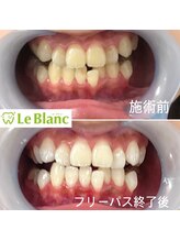 ルブラン 奈良店(Le Blanc)/ホワイトニングお済みですか？