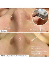 ミエル 神戸店(Miel)/毛穴洗浄で汚れをごっそり除去